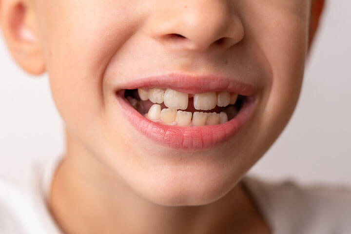 子供の内から行う歯列矯正について